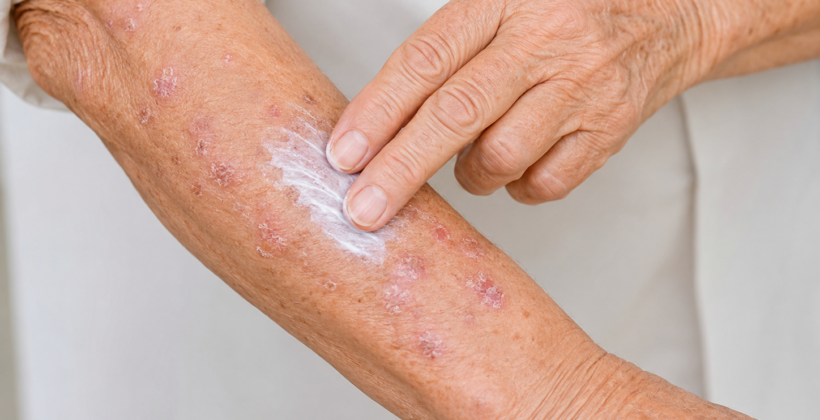 Efurix: o que é, para que serve e como é a evolução do tratamento