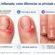 Unha inflamada: principais causas, como diferenciar e como tratar
