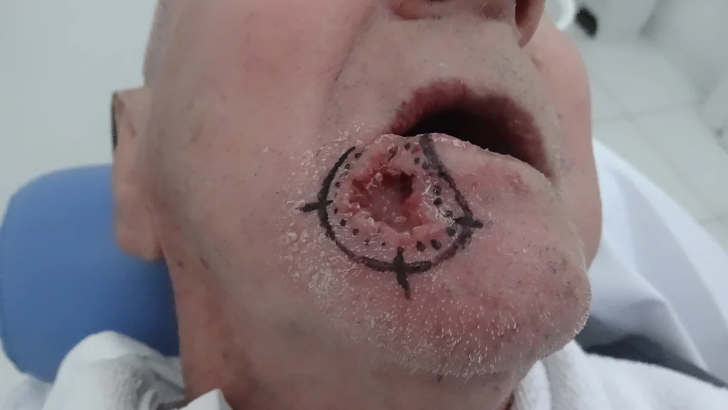 carcinoma epidermoide avançado em labio inferior a direita 