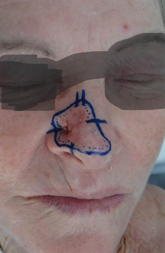 foto de um cancer de pele grande no nariz, deliitado com caneta de marcação azul
