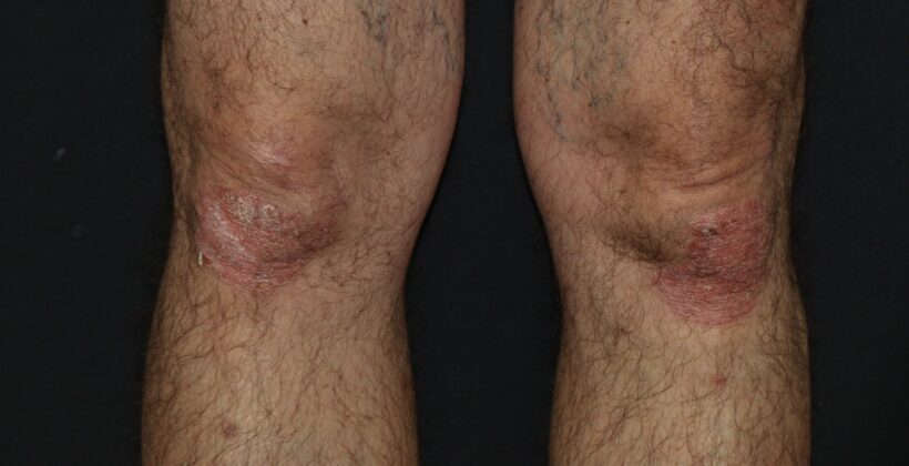 Como tratar a psoríase: pomadas, fototerapia, metotrexato e imunobiológicos Como tratar a psoríase: pomadas, fototerapia, metotrexato e imunobiológicos