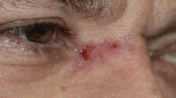 Cicatrização por segunda intenção: quando deixar a ferida cicatrizar sem pontos? Cicatrização por segunda intenção: quando deixar a ferida cicatrizar sem pontos?