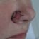 Cirurgia de Mohs para câncer de pele: por que é considerada a técnica mais efetiva?