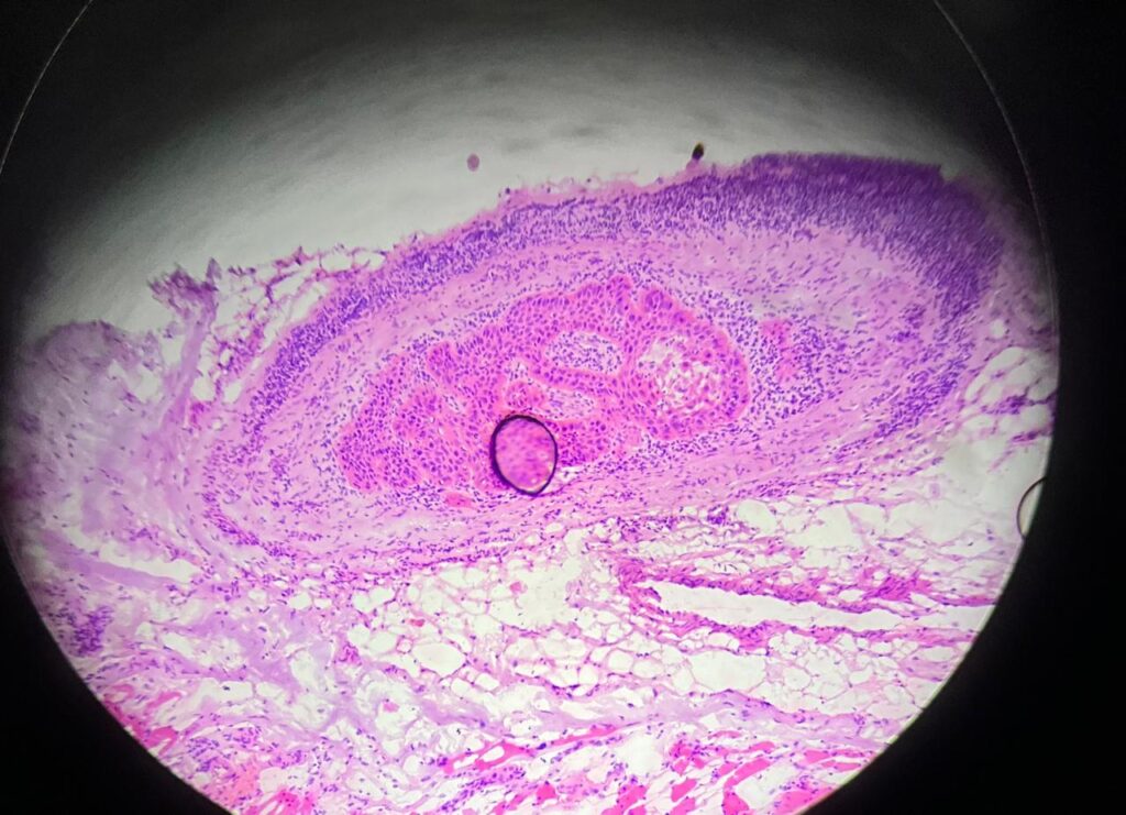 Imagem microscópica de câncer de pele com área sugestiva de invasão perineural destacada em círculo.