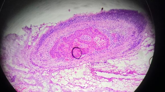 Invasão perineural no câncer de pele: o que significa?