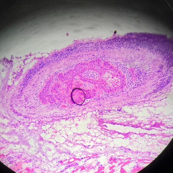 Invasão perineural no câncer de pele: o que significa? Invasão perineural no câncer de pele: o que significa?
