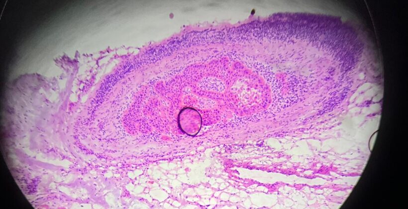 Invasão perineural no câncer de pele: o que significa?