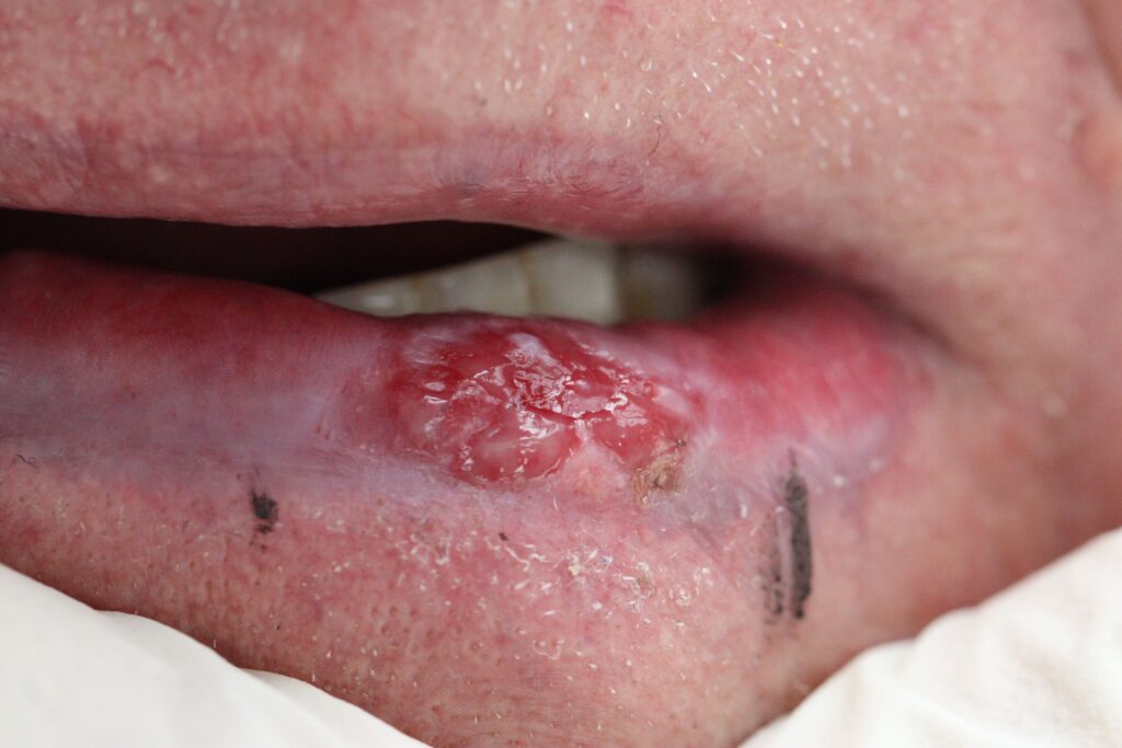 ferida em labio que nao cicatriza