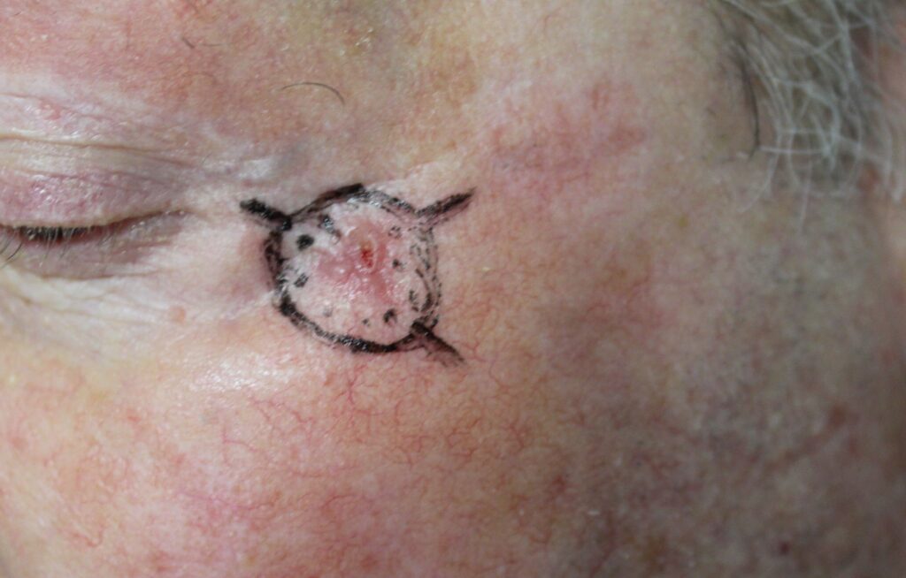 Delimitação de lesão suspeita de câncer de pele no canto externo do olho antes da cirurgia micrográfica de Mohs.