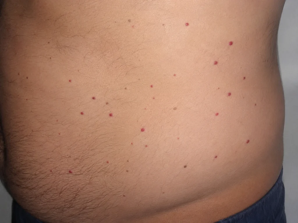 Bolinhas vermelhas compatíveis com hemangiomas rubi na lateral da barriga de um homem adulto.