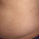 Bolinhas vermelhas na barriga: pode ser hemangioma rubi?