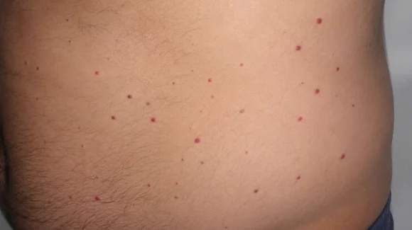 Bolinhas vermelhas na barriga: pode ser hemangioma rubi?