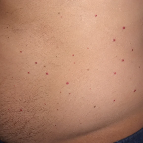 Bolinhas vermelhas na barriga: pode ser hemangioma rubi?