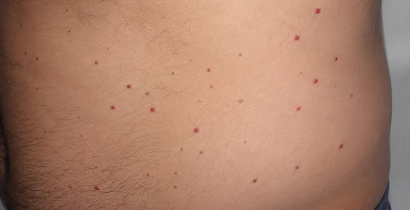 Bolinhas vermelhas na barriga: pode ser hemangioma rubi?