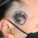 Cirurgia para melanoma: margens, Breslow e tratamento