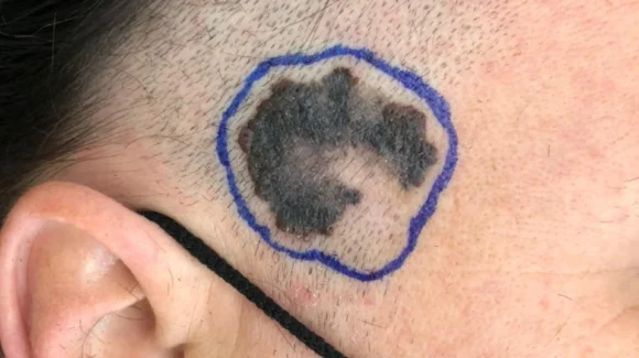 Cirurgia para melanoma: margens, Breslow e tratamento Cirurgia para melanoma: margens, Breslow e tratamento