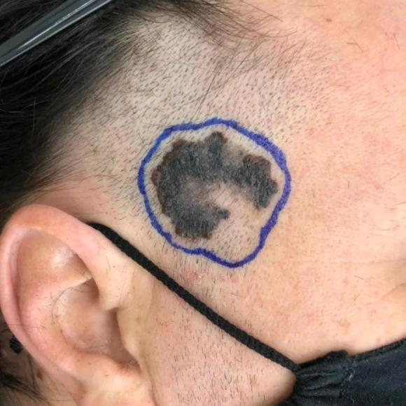 Cirurgia para melanoma: margens, Breslow e tratamento