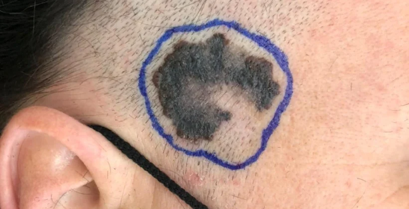 Cirurgia para melanoma: margens, Breslow e tratamento
