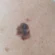 Melanoma em Rio do Sul