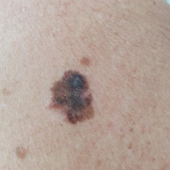 Melanoma em Rio do Sul
