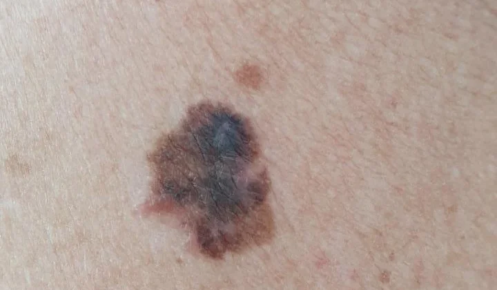 Melanoma em Rio do Sul