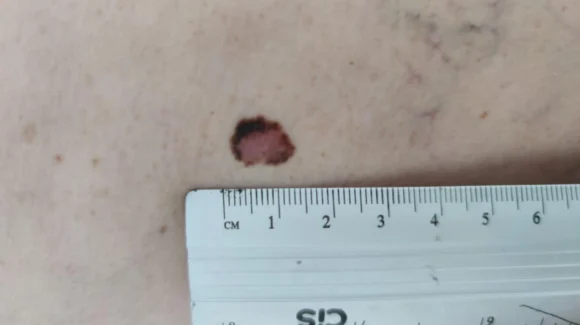 Linfonodo sentinela no melanoma: quando fazer? Linfonodo sentinela no melanoma: quando fazer?