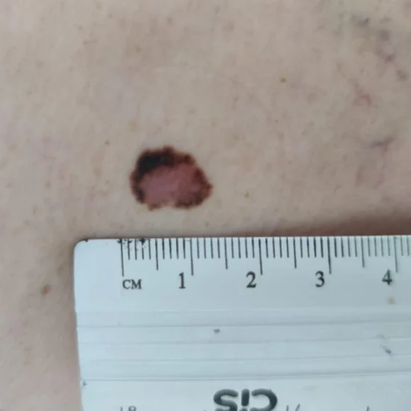 Linfonodo sentinela no melanoma: quando fazer?