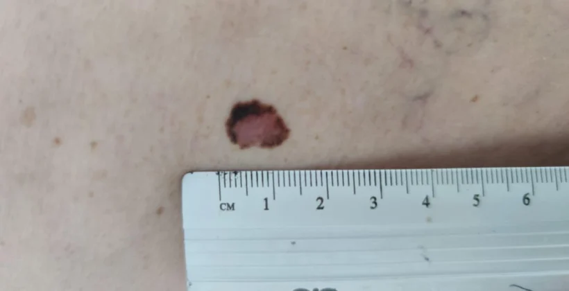 Linfonodo sentinela no melanoma: quando fazer? Linfonodo sentinela no melanoma: quando fazer?