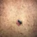 Tipos de melanoma maligno: quais são e como identificar