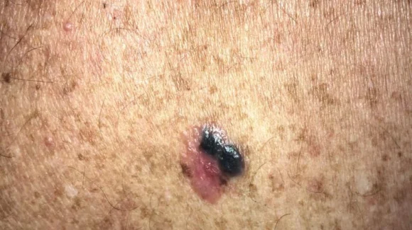 Tipos de melanoma maligno: quais são e como identificar