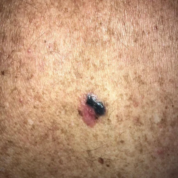 Tipos de melanoma maligno: quais são e como identificar