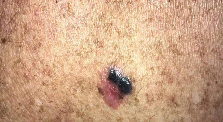 Tipos de melanoma maligno: quais são e como identificar