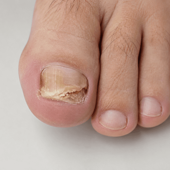 Micose nas unhas: quando suspeitar, quais exames fazer e como tratar