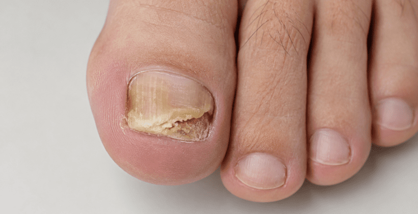 Micose nas unhas: quando suspeitar, quais exames fazer e como tratar Micose nas unhas: quando suspeitar, quais exames fazer e como tratar