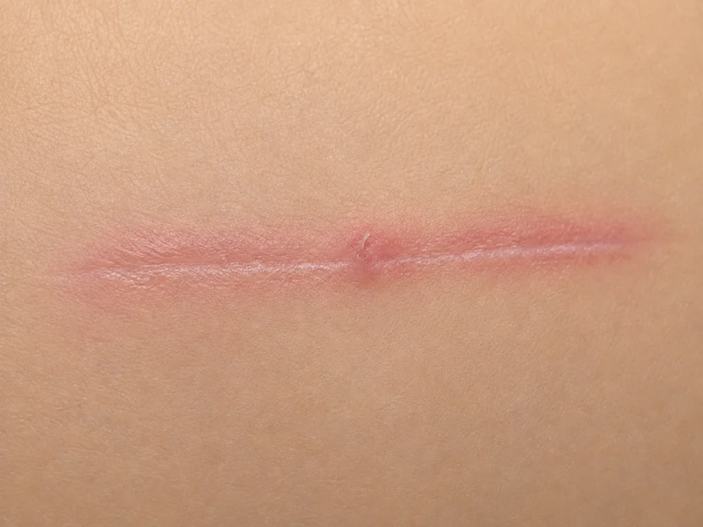 Fio de sutura absorvível Monocryl saindo no centro de uma cicatriz cirúrgica recente com leve inflamação local