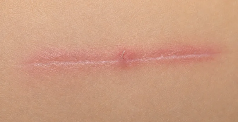 Pontos internos na cirurgia: o que são e por que podem sair pela cicatriz?