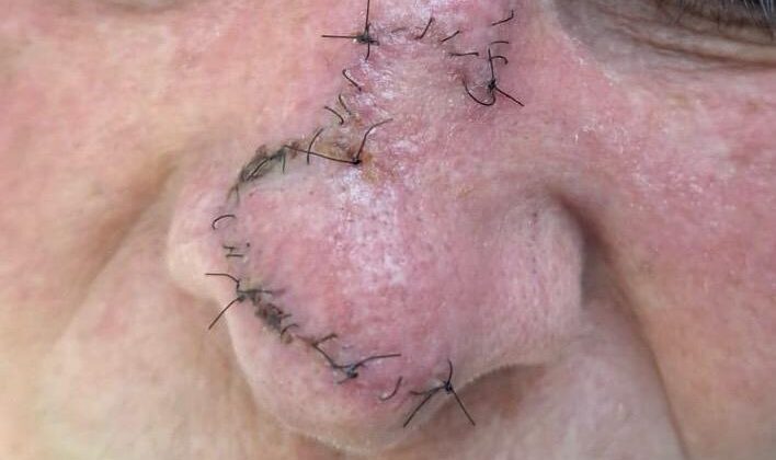 Com quantos dias devo retirar os pontos de uma cirurgia?