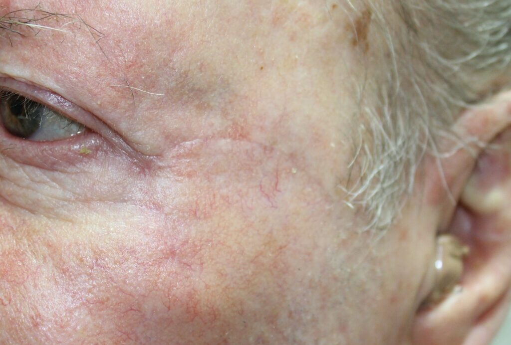 Pós-operatório de 10 dias após cirurgia micrográfica de Mohs em lesão próxima ao canto externo do olho.