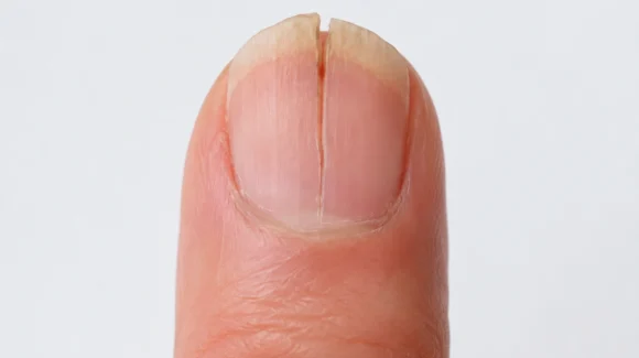 Unha rachada ao meio: o que pode ser e quando procurar dermatologista Unha rachada ao meio: o que pode ser e quando procurar dermatologista