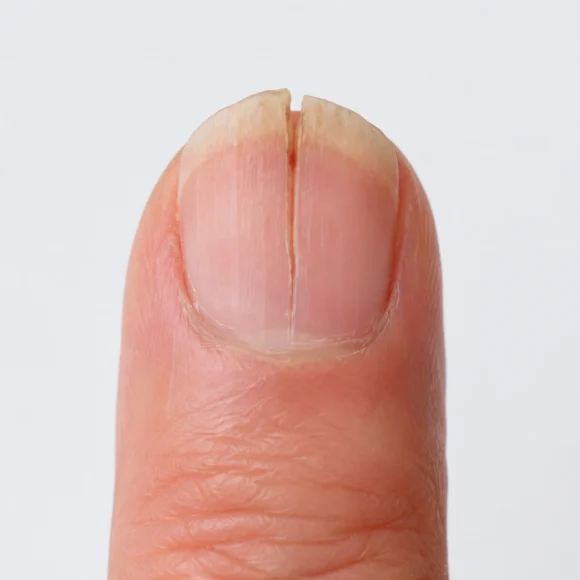 Unha rachada ao meio: o que pode ser e quando procurar dermatologista