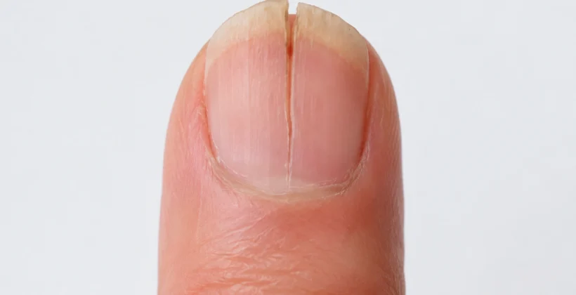 Unha rachada ao meio: o que pode ser e quando procurar dermatologista Unha rachada ao meio: o que pode ser e quando procurar dermatologista