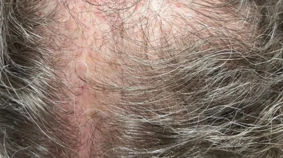 Dermatologista especialista em queda de cabelo Dermatologista especialista em queda de cabelo
