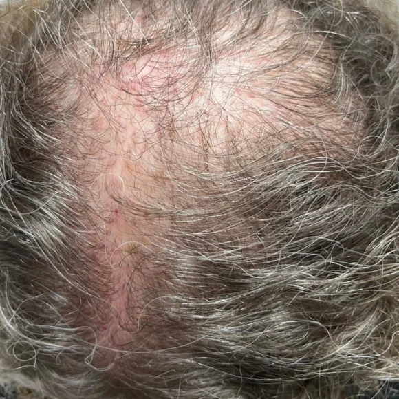 Dermatologista especialista em queda de cabelo