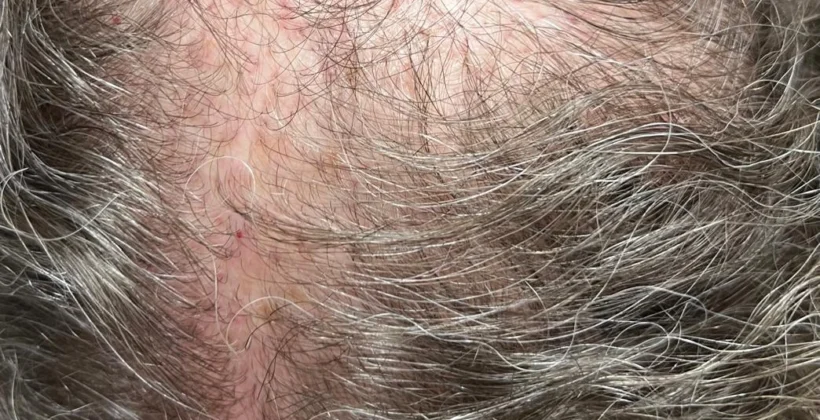 Dermatologista especialista em queda de cabelo