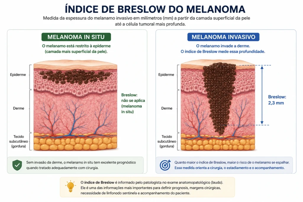 Infográfico comparando melanoma in situ e melanoma invasivo, com escala em milímetros mostrando como é medida a espessura de Breslow na pele.