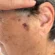 Lentigo maligno melanoma: mancha na face pode ser câncer