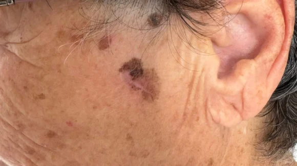 Lentigo maligno melanoma: mancha na face pode ser câncer Lentigo maligno melanoma: mancha na face pode ser câncer