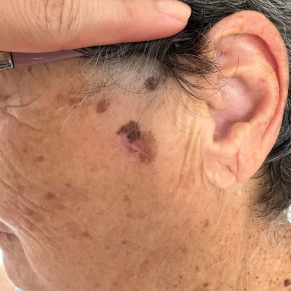 Lentigo maligno melanoma: mancha na face pode ser câncer
