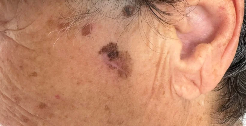 Lentigo maligno melanoma: mancha na face pode ser câncer