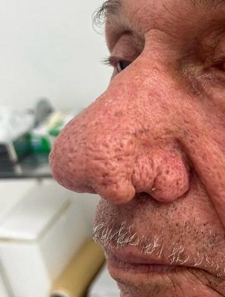 Rinofima: o que é, início, fotos e tratamento